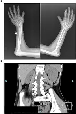 Trio Clinical Exome Sequencing in a Patient With Multicentric Carpotarsal Osteolysis Syndrome: First Case Report in the Balkans